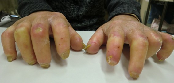 強皮症患者の皮膚硬化および指尖部潰瘍瘢痕