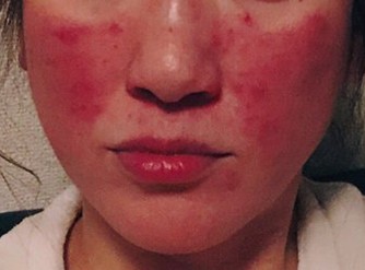 蝶形紅斑
