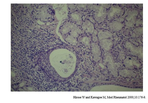 シェーグレン症候群患者の小唾液腺組織