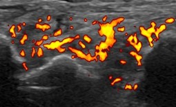 関節リウマチ患者における関越超音波検査でのパワードプラー信号