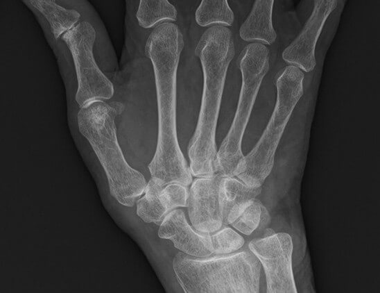 早期関節リウマチ患者の手関節X線写真
