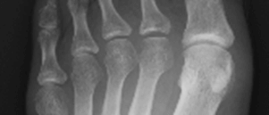 関節リウマチ患者の足趾MTP関節のX線写真