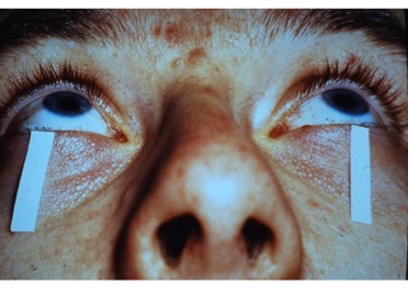 シルマーテスト