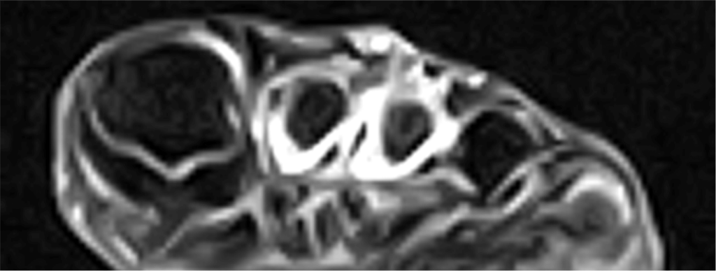 関節リウマチ患者の造影MRI所見